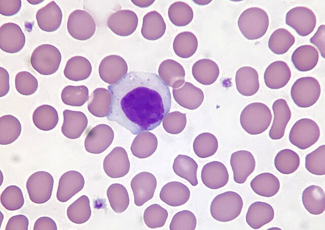 WIKIMEDIA COMMONS | UPenn professor Dr. David Teachey detailed health equity efforts in diagnosing and treating T-ALL and lymphoma, rare types of blood cancer, at an event hosted by the Lombardi Comprehensive Cancer Center on Nov. 15.